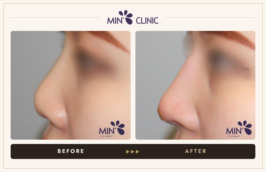 Nose filler before and after, case 53 – MIN Clinic Seoul