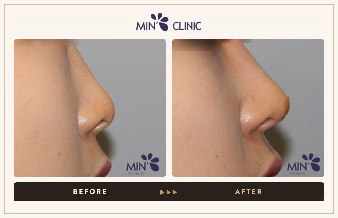 Nose filler before and after, case 54 – MIN Clinic Seoul