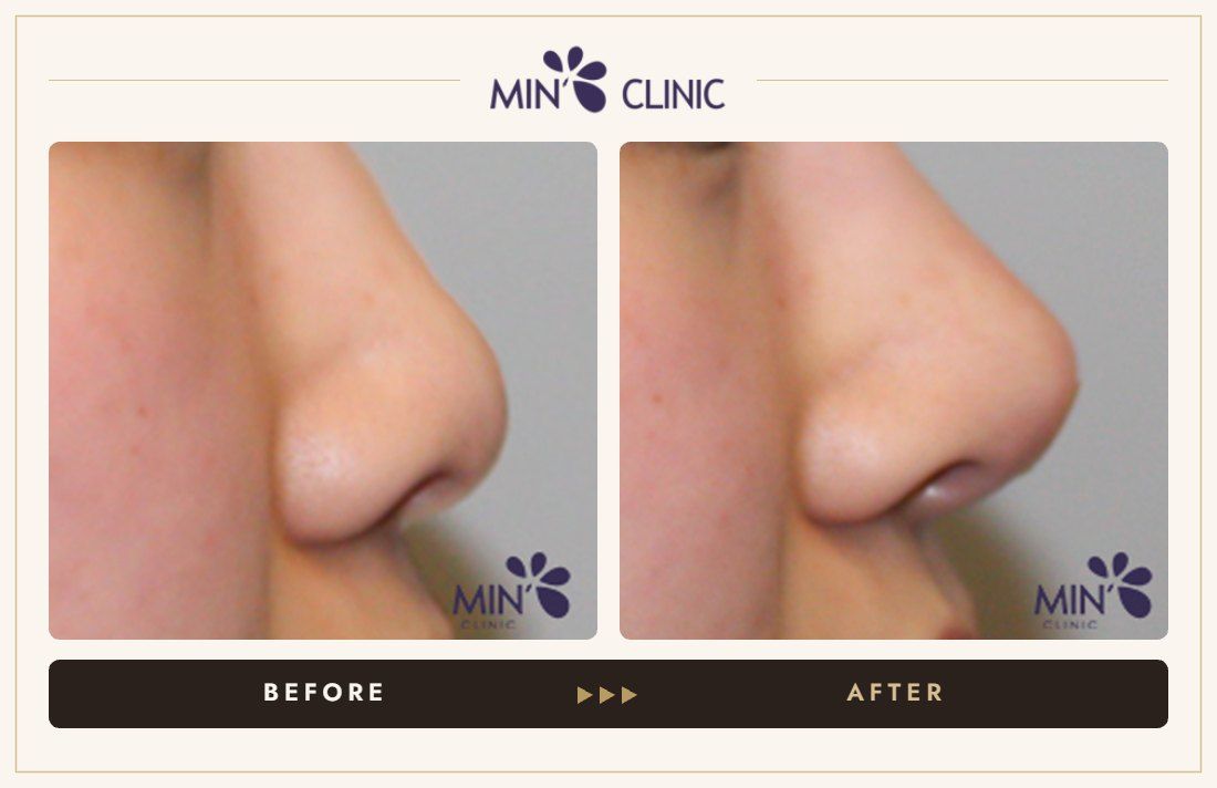 Nose filler before and after, case 55 – MIN Clinic Seoul