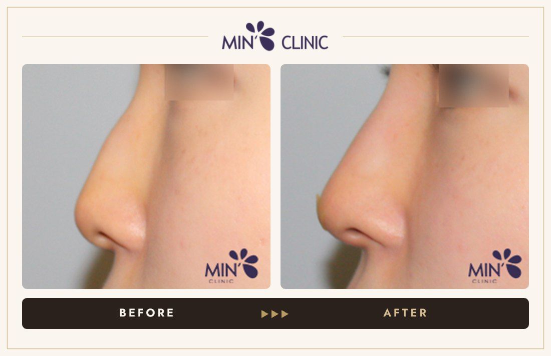 Nose filler before and after, case 56 – MIN Clinic Seoul