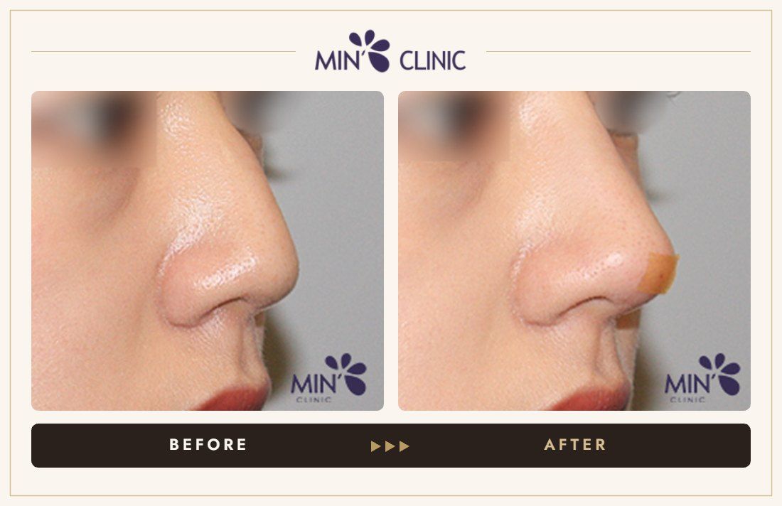 Nose filler before and after, case 57 – MIN Clinic Seoul