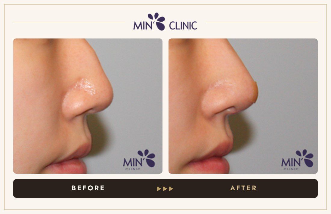 Nose filler before and after, case 58 – MIN Clinic Seoul