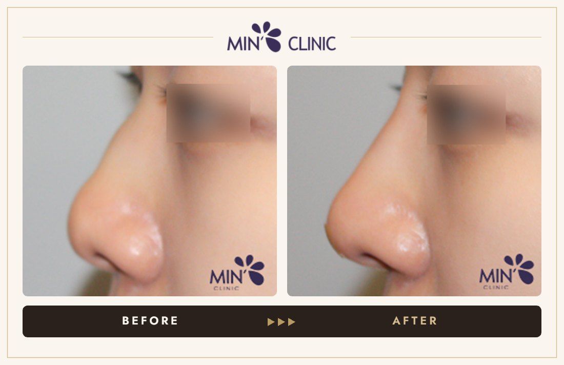 Nose filler before and after, case 59 – MIN Clinic Seoul