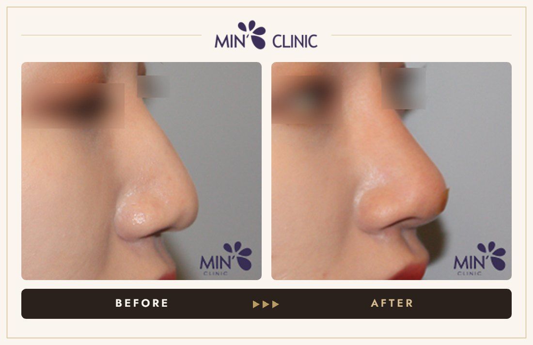 Nose filler before and after, case 60 – MIN Clinic Seoul
