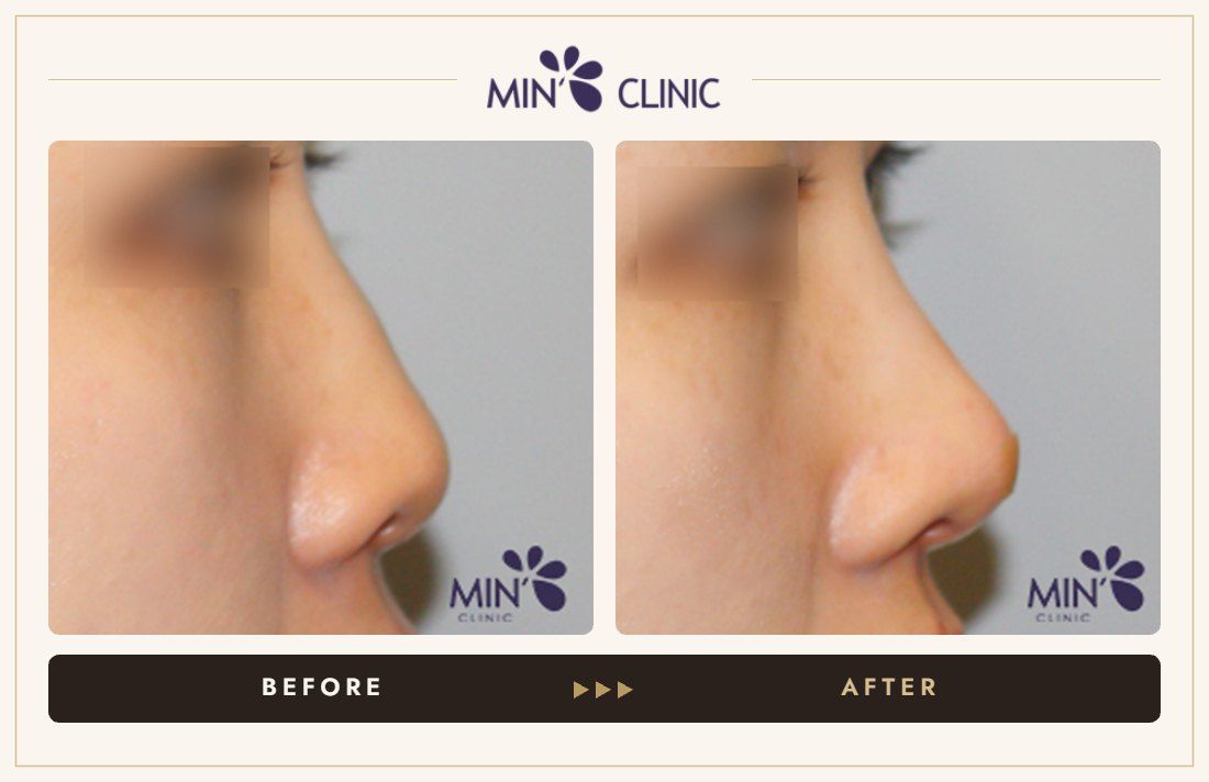 Nose filler before and after, case 61 – MIN Clinic Seoul