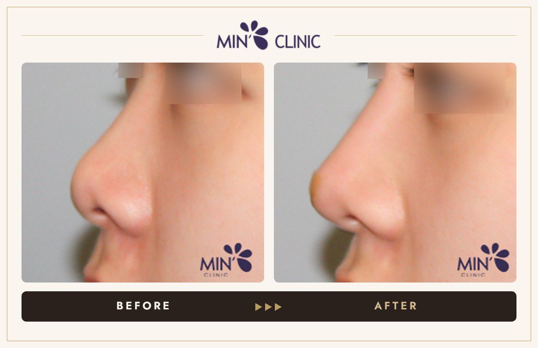 Nose filler before and after, case 62 – MIN Clinic Seoul