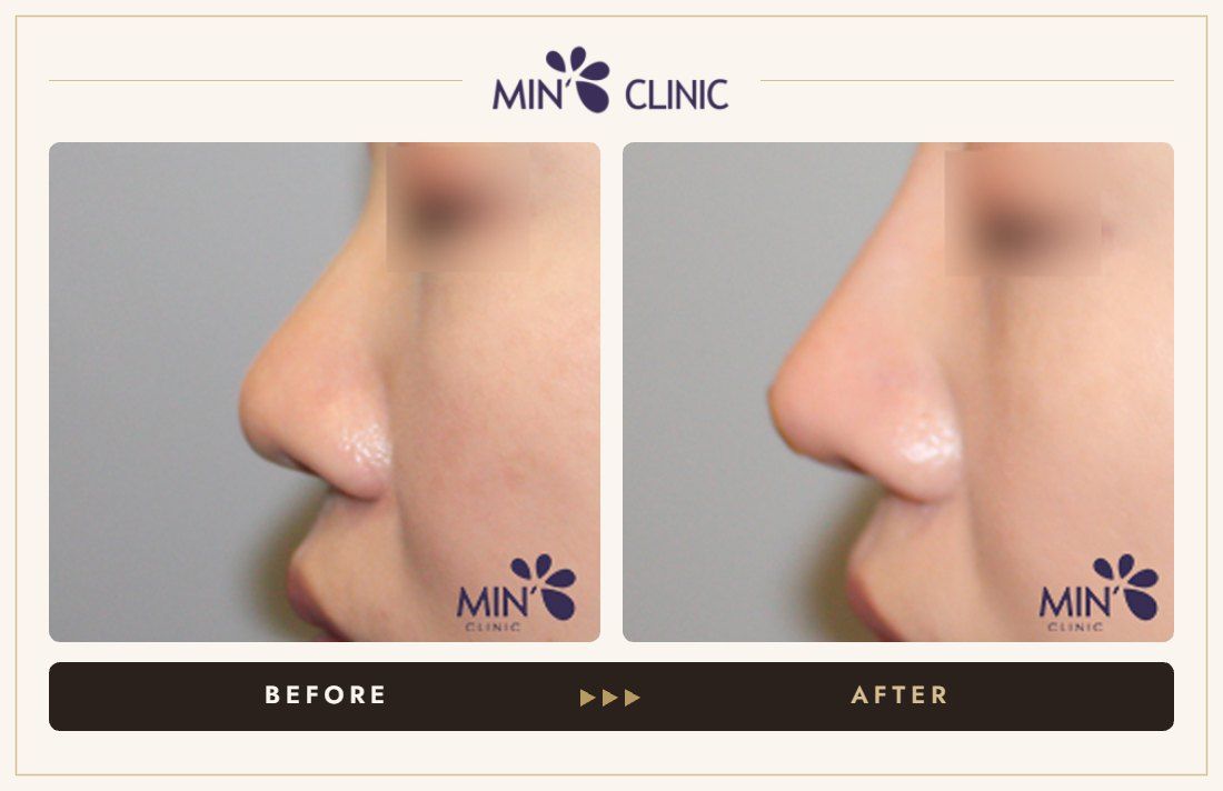 Nose filler before and after, case 63 – MIN Clinic Seoul