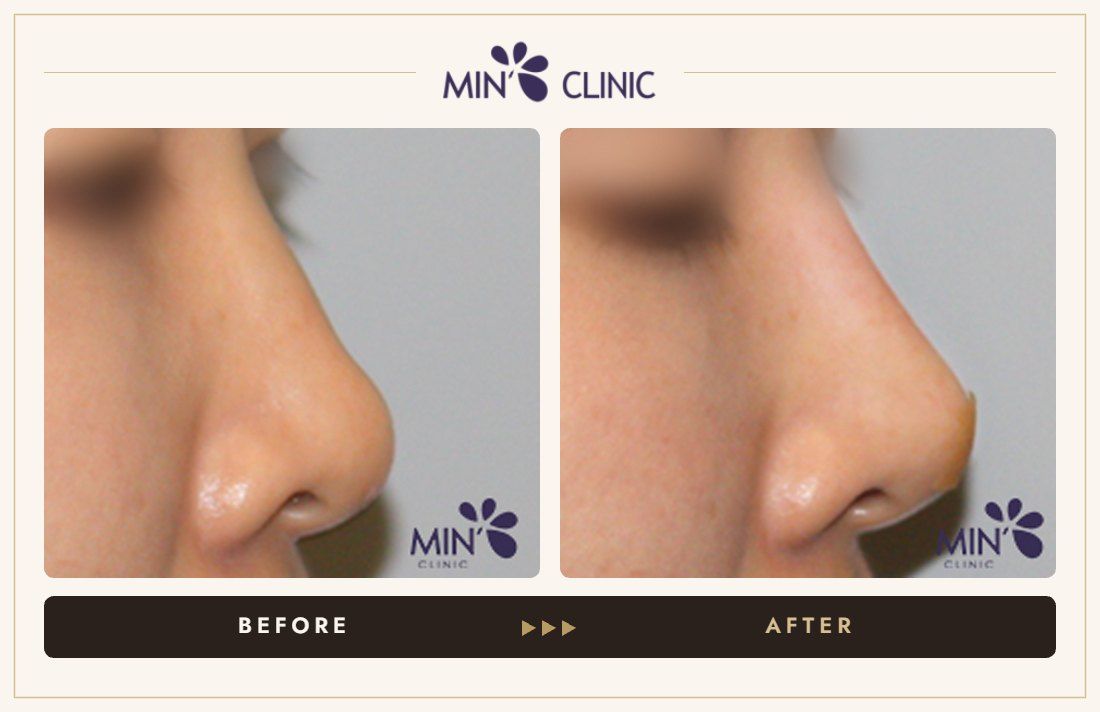 Nose filler before and after, case 64 – MIN Clinic Seoul