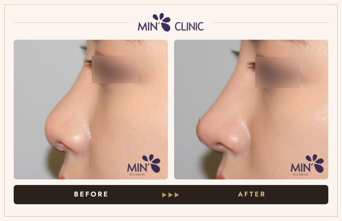 Nose filler before and after, case 65 – MIN Clinic Seoul