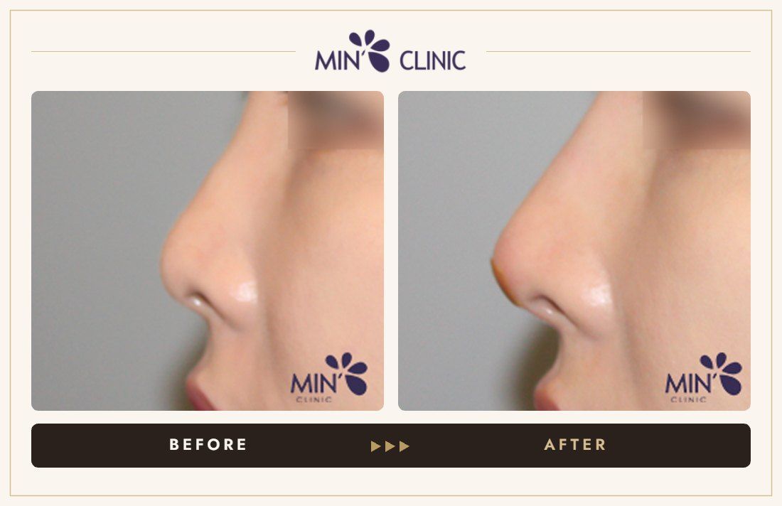 Nose filler before and after, case 66 – MIN Clinic Seoul