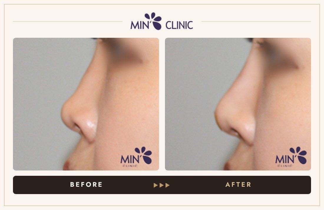 Nose filler before and after, case 67 – MIN Clinic Seoul
