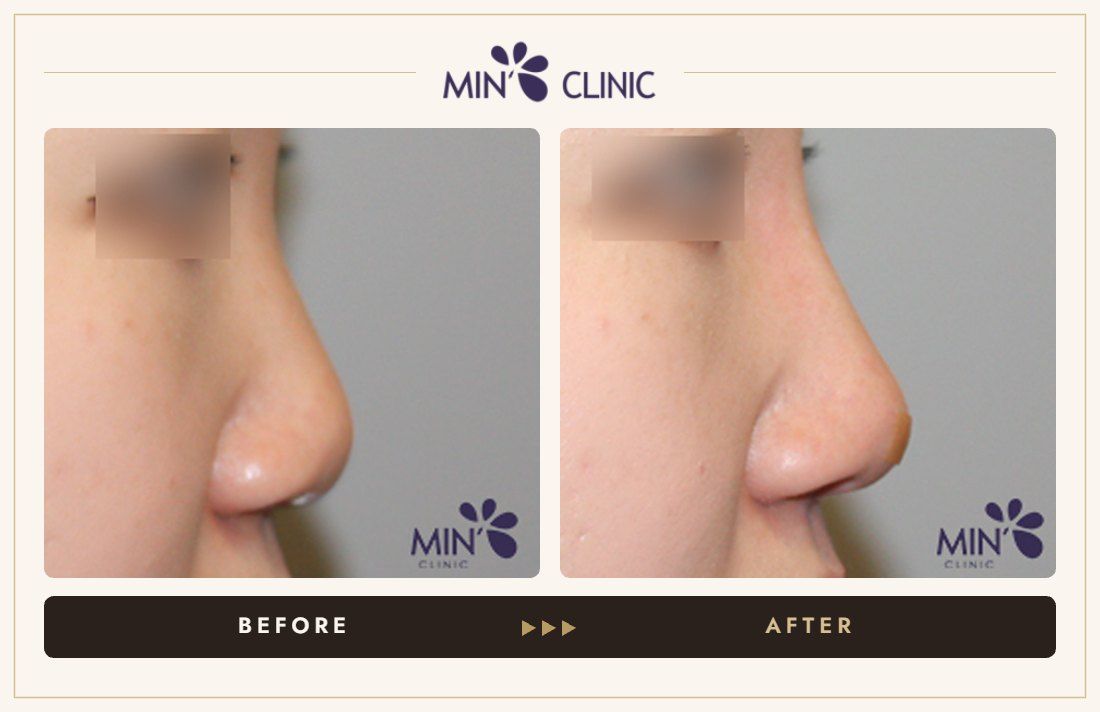 Nose filler before and after, case 68 – MIN Clinic Seoul