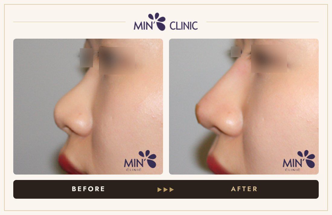 Nose filler before and after, case 69 – MIN Clinic Seoul