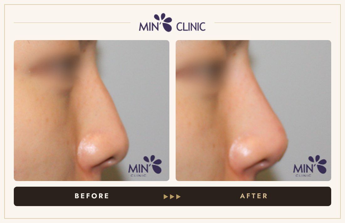 Nose filler before and after, case 70 – MIN Clinic Seoul