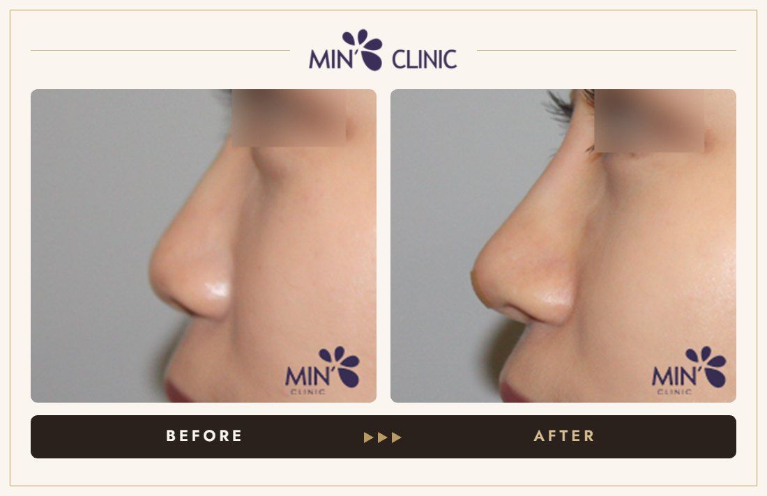 Nose filler before and after, case 71 – MIN Clinic Seoul
