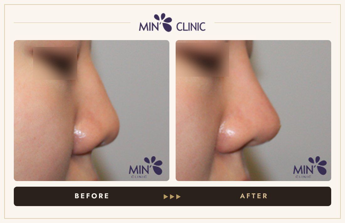 Nose filler before and after, case 72 – MIN Clinic Seoul