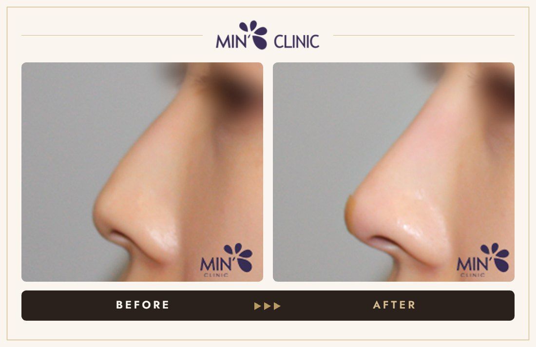 Nose filler before and after, case 73 – MIN Clinic Seoul