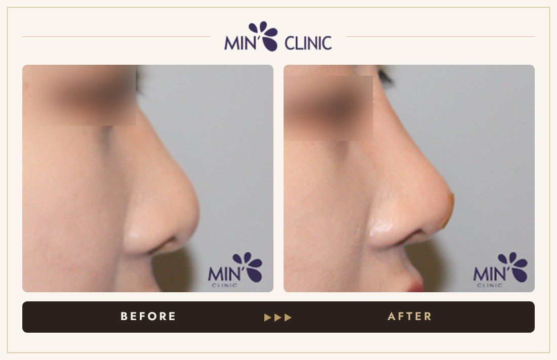 Nose filler before and after, case 74 – MIN Clinic Seoul