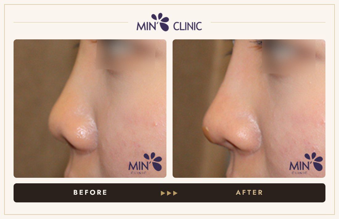 Nose filler before and after, case 75 – MIN Clinic Seoul