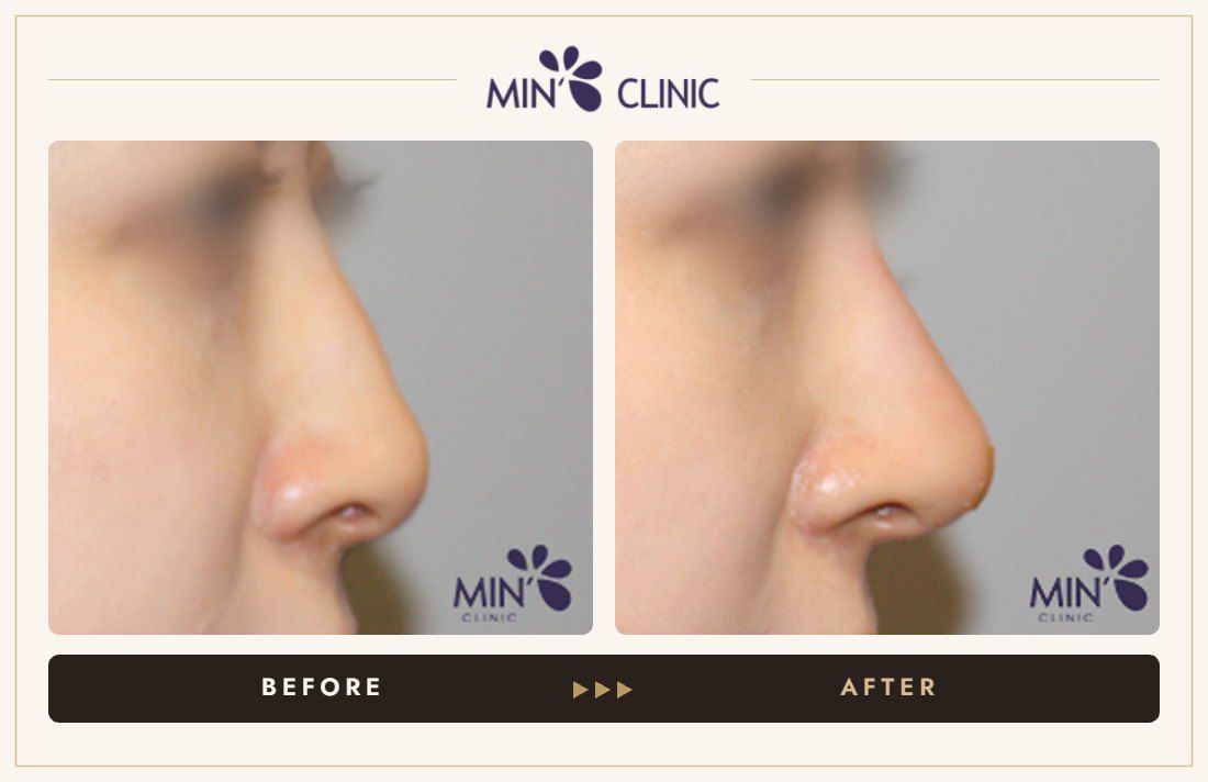 Nose filler before and after, case 76 – MIN Clinic Seoul