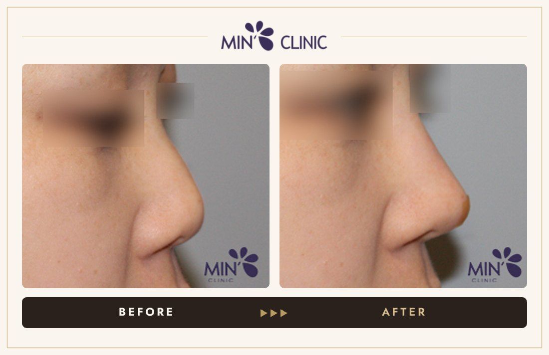 Nose filler before and after, case 77 – MIN Clinic Seoul