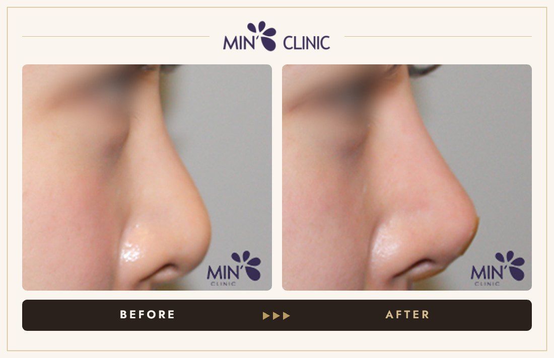 Nose filler before and after, case 78 – MIN Clinic Seoul