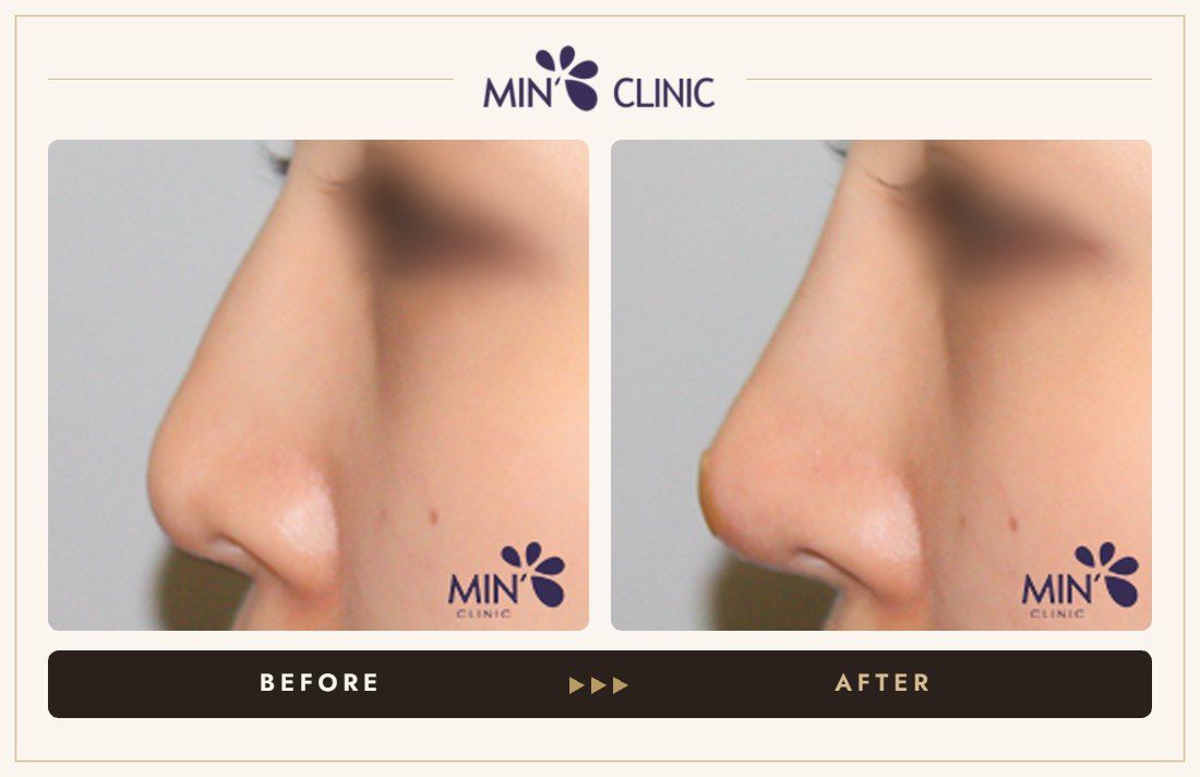 Nose filler before and after, case 79 – MIN Clinic Seoul