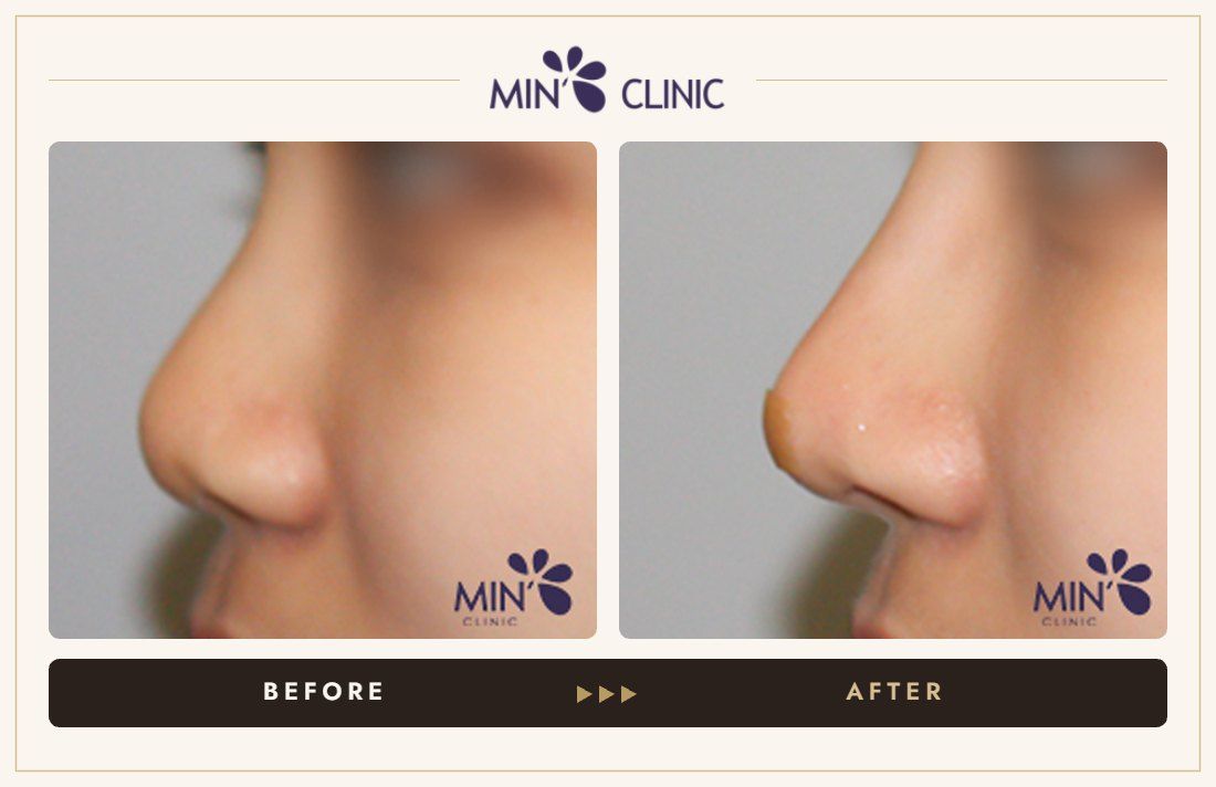 Nose filler before and after, case 80 – MIN Clinic Seoul
