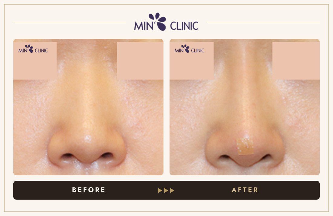 Nose filler before and after, case 81 – MIN Clinic Seoul