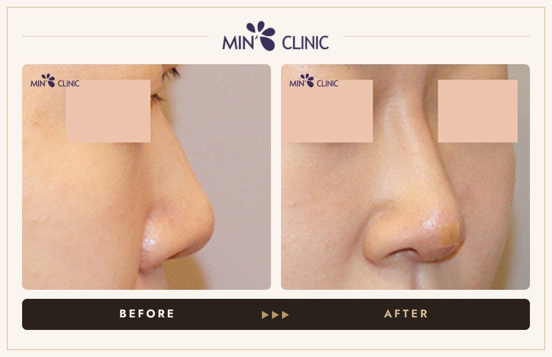 Nose filler before and after, case 82 – MIN Clinic Seoul
