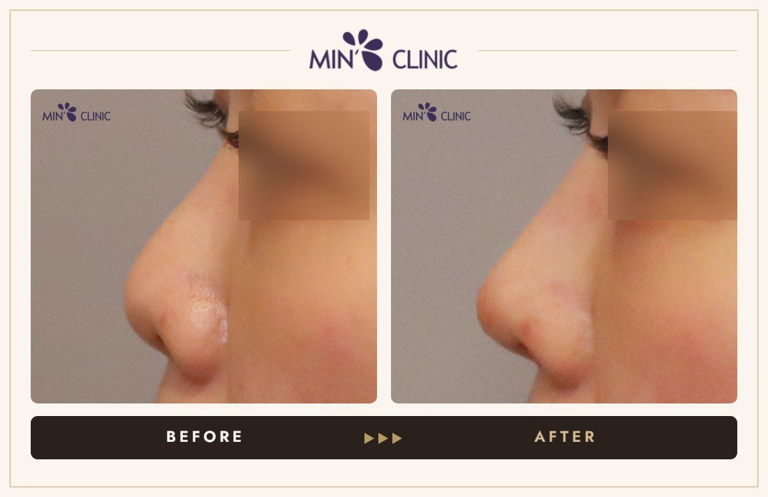 Nose filler before and after, case 83 – MIN Clinic Seoul