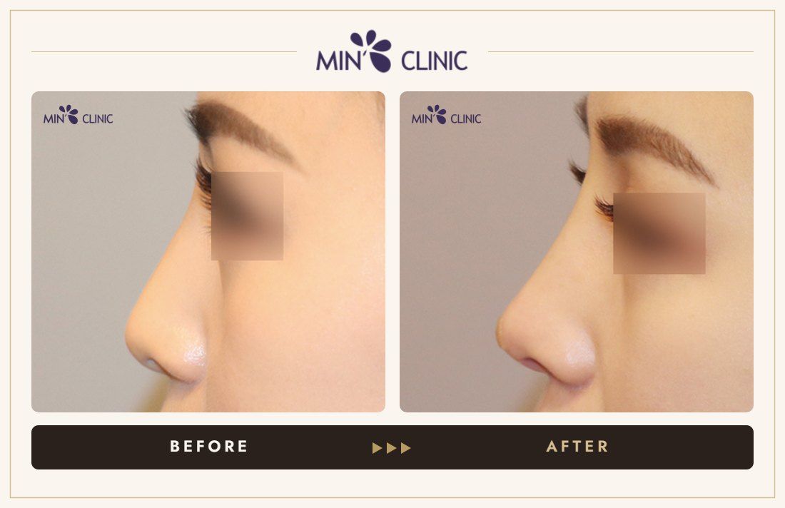 Nose filler before and after, case 84 – MIN Clinic Seoul