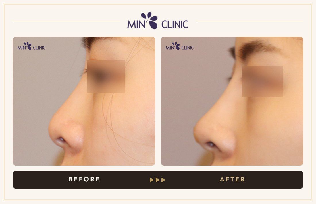 Nose filler before and after, case 85 – MIN Clinic Seoul