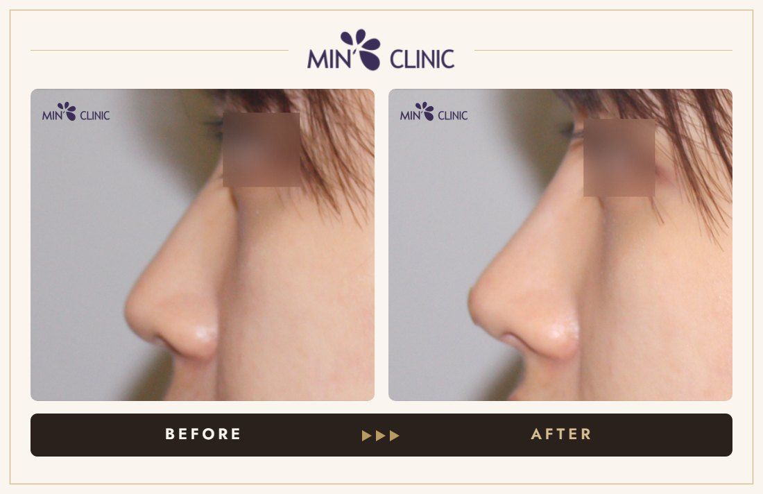 Nose filler before and after, case 86 – MIN Clinic Seoul