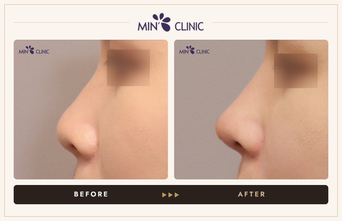 Nose filler before and after, case 87 – MIN Clinic Seoul