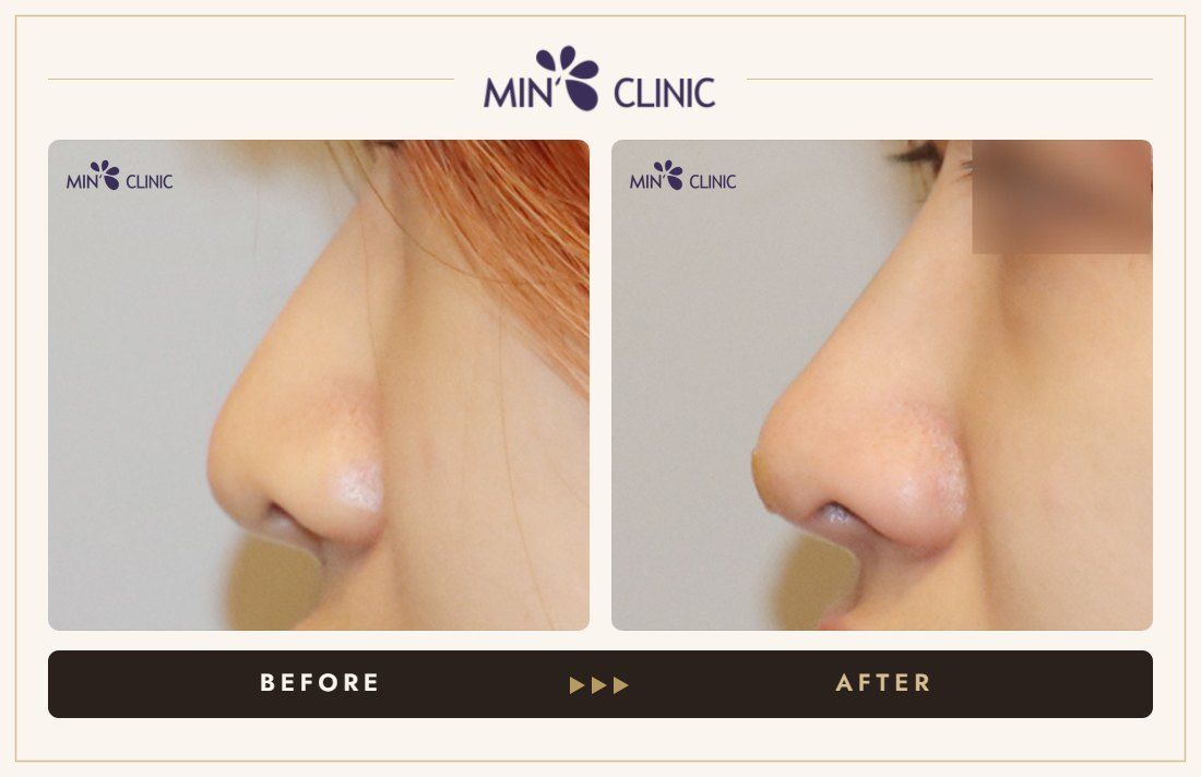 Nose filler before and after, case 88 – MIN Clinic Seoul