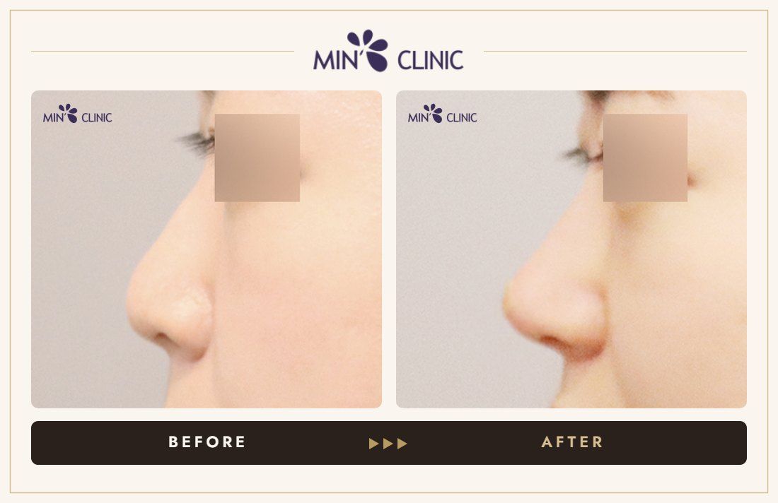 Nose filler before and after, case 89 – MIN Clinic Seoul