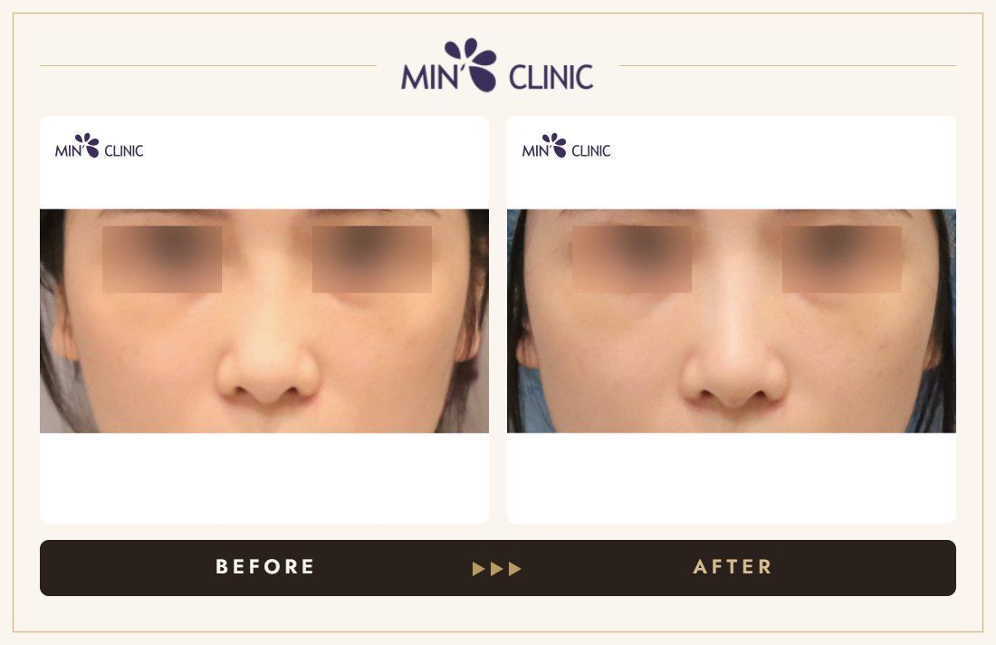 Nose filler before and after, case 90 – MIN Clinic Seoul