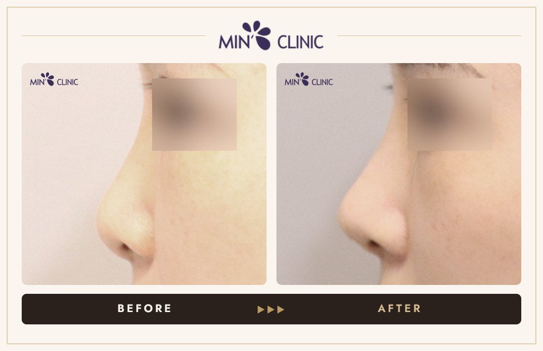 Nose filler before and after, case 91 – MIN Clinic Seoul