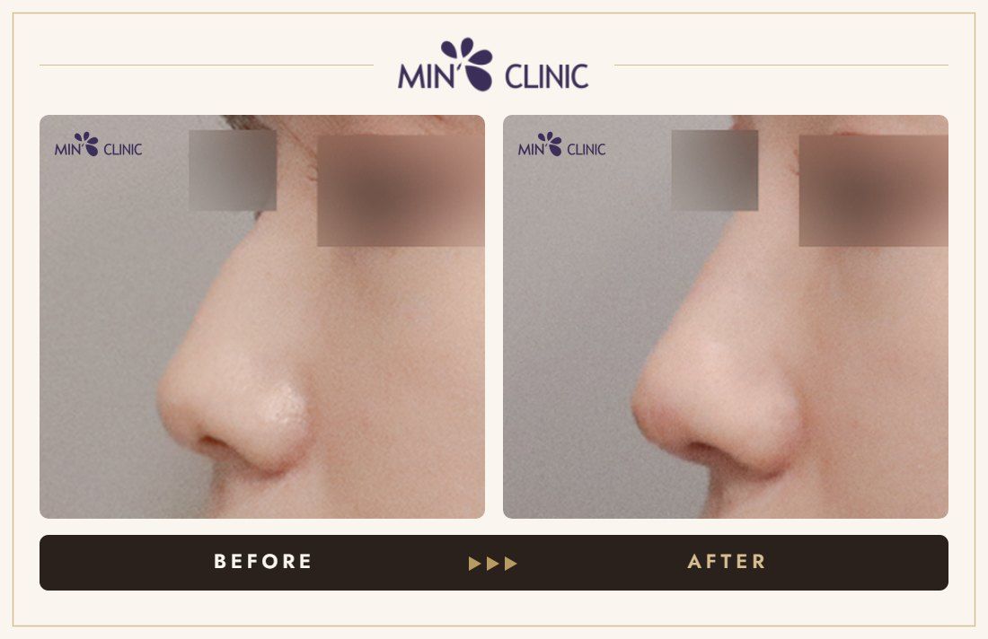 Nose filler before and after, case 93 – MIN Clinic Seoul