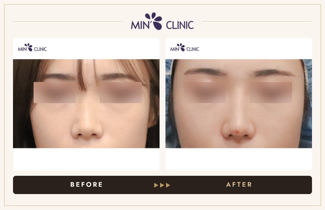 Nose filler before and after, case 94 – MIN Clinic Seoul
