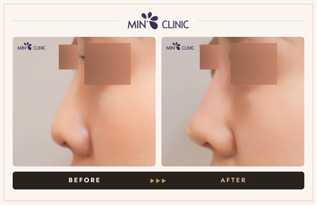 Nose filler before and after, case 95 – MIN Clinic Seoul