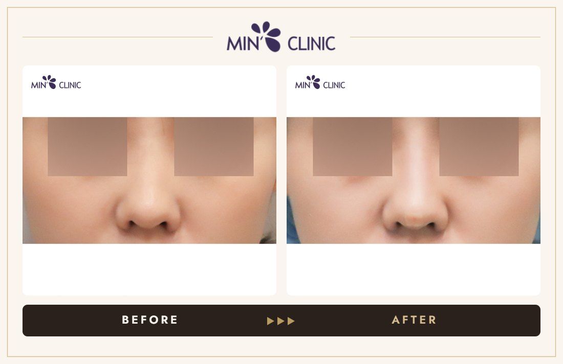 Nose filler before and after, case 96 – MIN Clinic Seoul