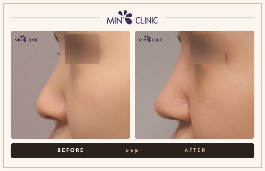 Nose filler before and after, case 97 – MIN Clinic Seoul