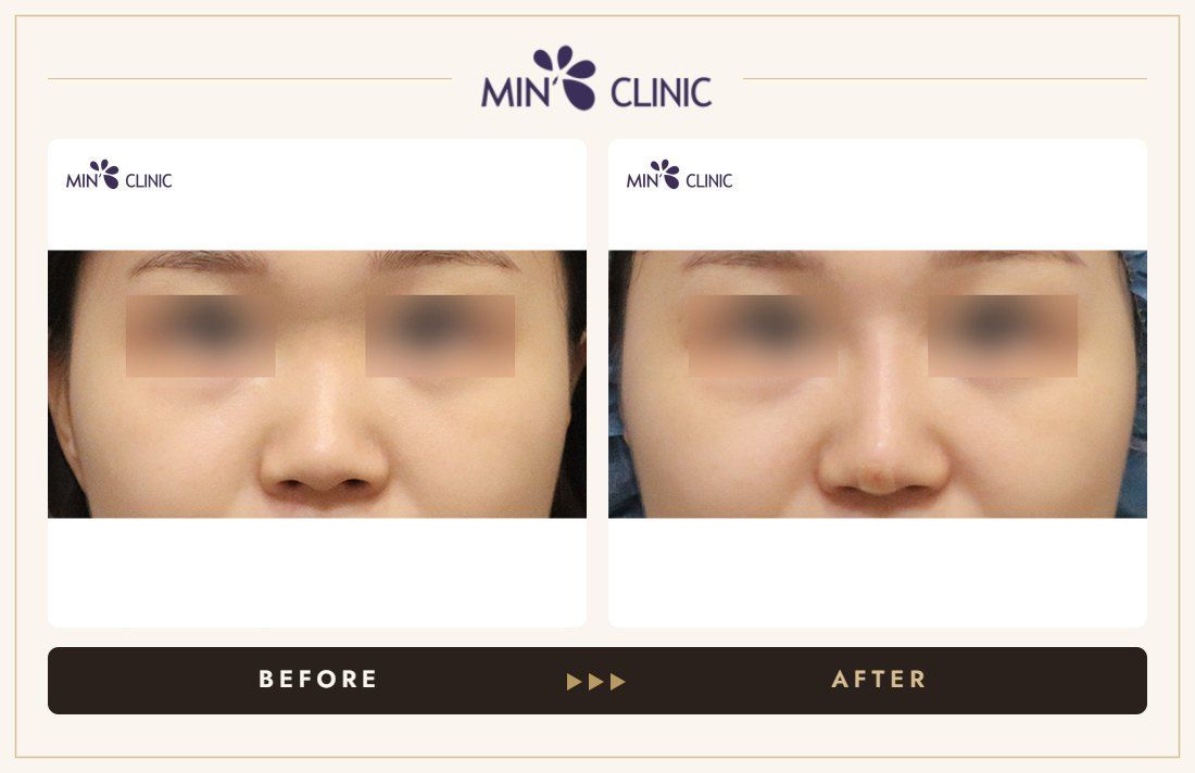 Nose filler before and after, case 98 – MIN Clinic Seoul
