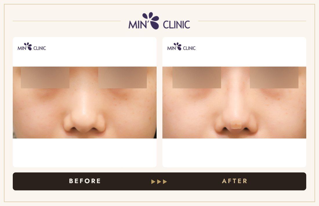 Nose filler before and after, case 99 – MIN Clinic Seoul