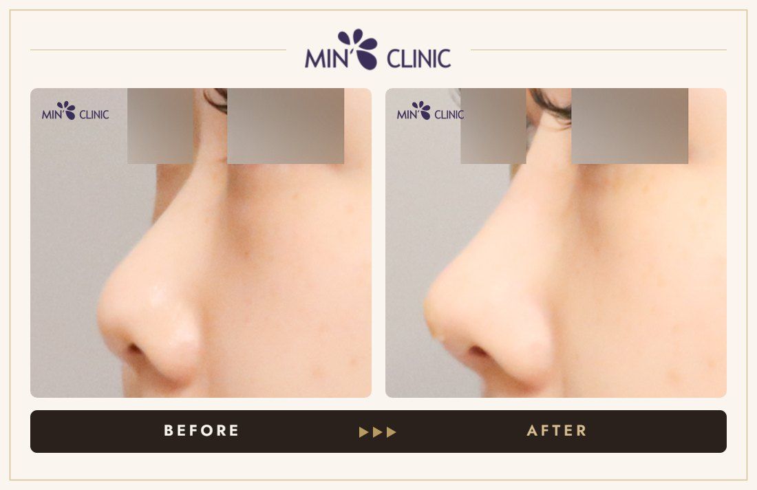 Nose filler before and after, case 100 – MIN Clinic Seoul