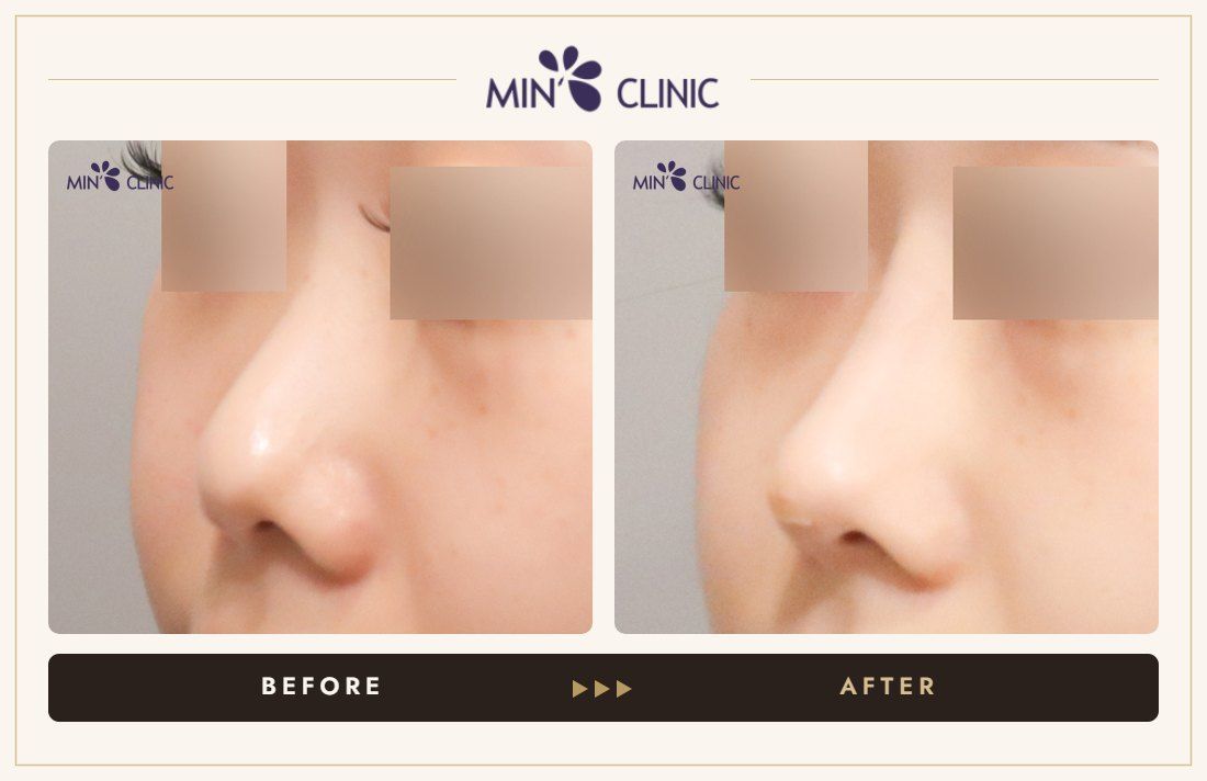 Nose filler before and after, case 101 – MIN Clinic Seoul