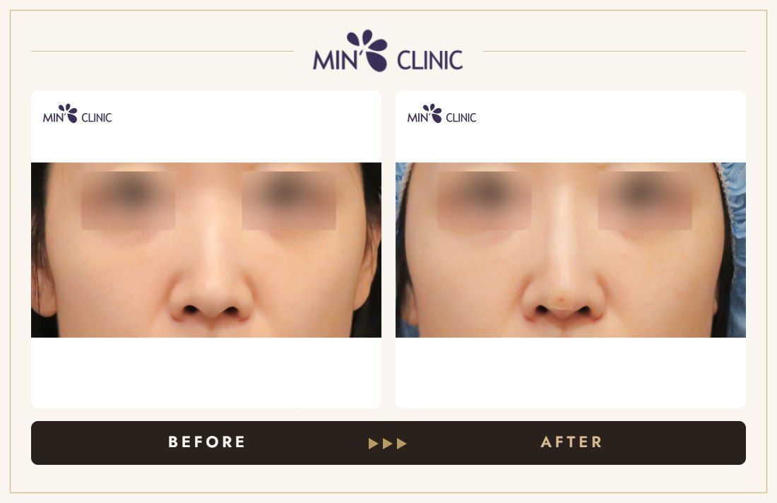 Nose filler before and after, case 102 – MIN Clinic Seoul