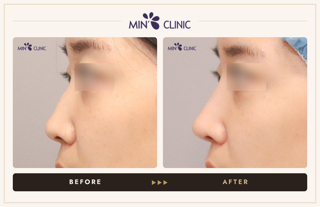 Nose filler before and after – MIN Clinic Gangnam, Seoul (case 103)